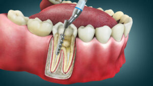 Root Canal Costs: What to Expect in Scottsdale