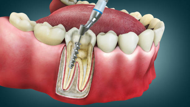 Root Canal Costs: What to Expect in Scottsdale