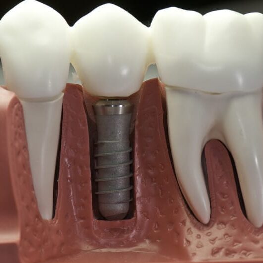 dental-implants