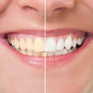 teeth-whitening
