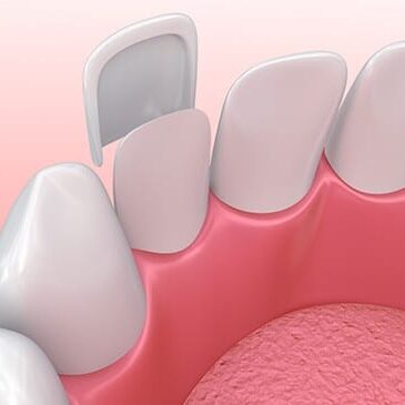 veneers
